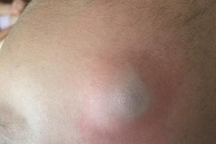 皮下血肿症状图