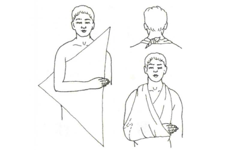 上肢悬吊包扎法图 上肢悬吊包扎法图