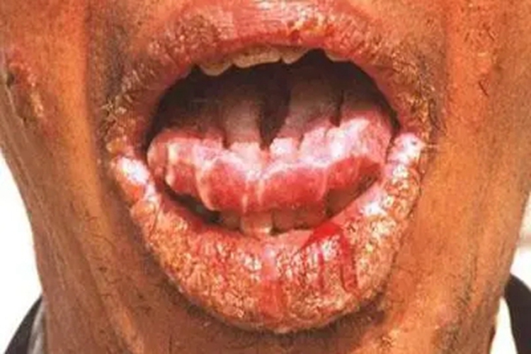 增殖型天疱疮裂口图