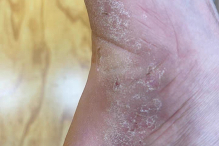 鳞屑角化型足癣脚部裂口图