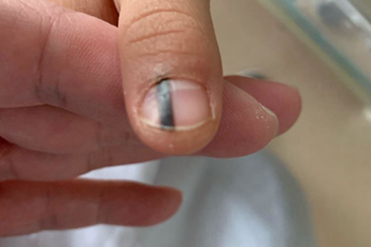 甲母痣手指甲症状图