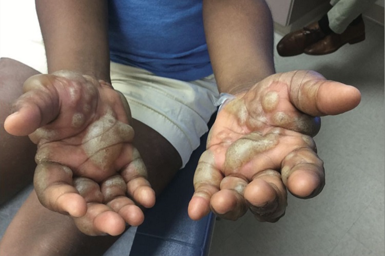 大疱性表皮松解症手掌大水疱图