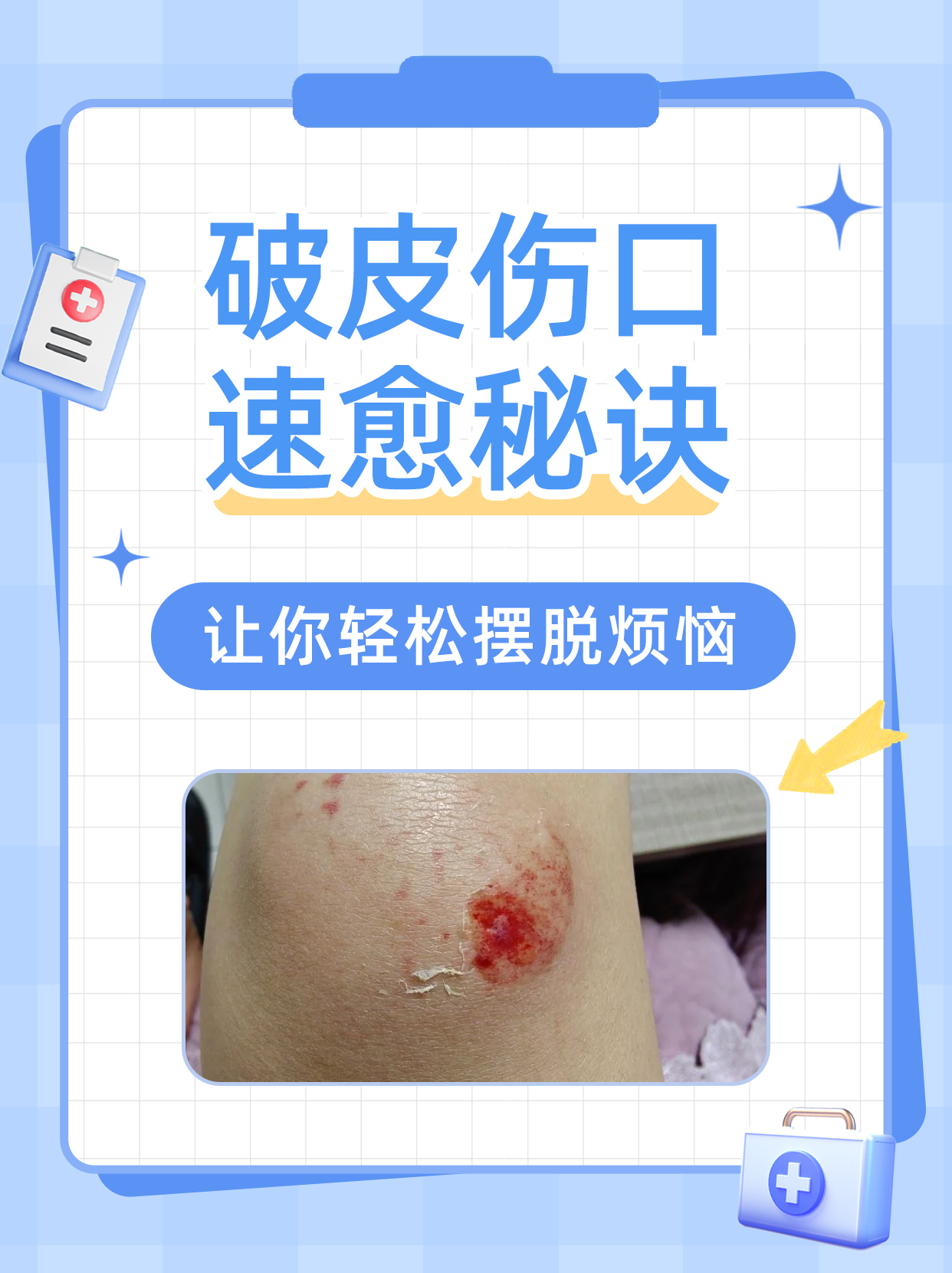 破皮伤口速愈秘诀，让你轻松摆脱烦恼！