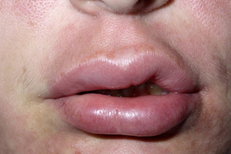 获得性血管性水肿皮肤变肿图 获得性血管性水肿皮肤变肿图