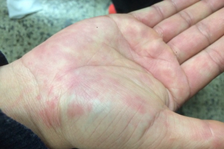 异型麻疹手掌很多红斑图