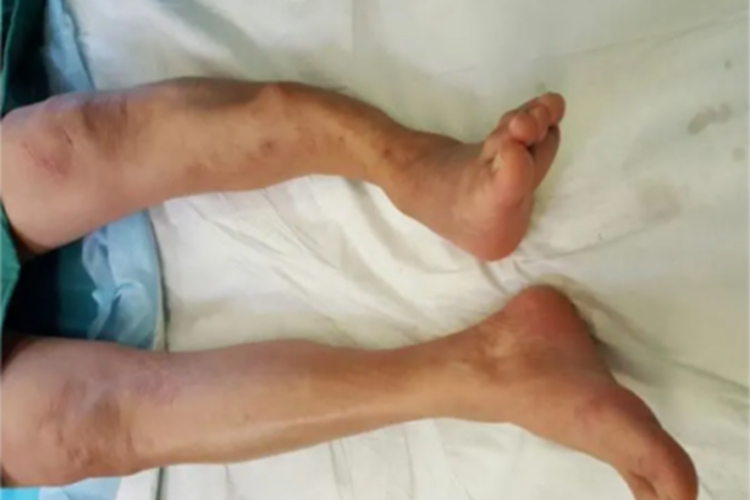 氟骨症左侧小腿变形图