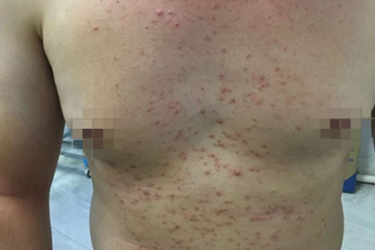 马拉色菌毛囊炎前胸症状图