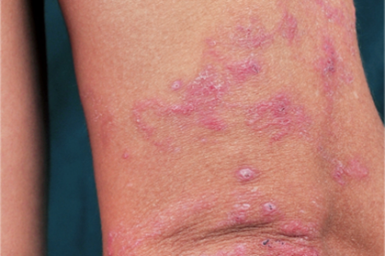皮肤幼虫移行症丘疹图