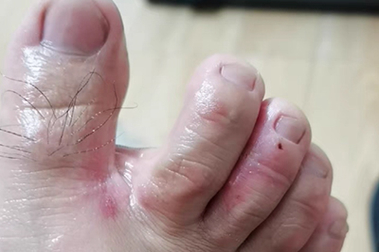 浸渍糜烂型足癣脚趾缝糜烂图