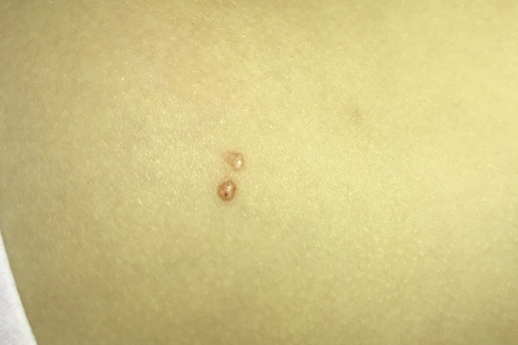 腰部传染性软疣图 腰部传染性软疣图