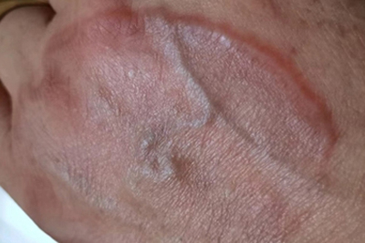 体癣手部红斑图 体癣手部红斑图