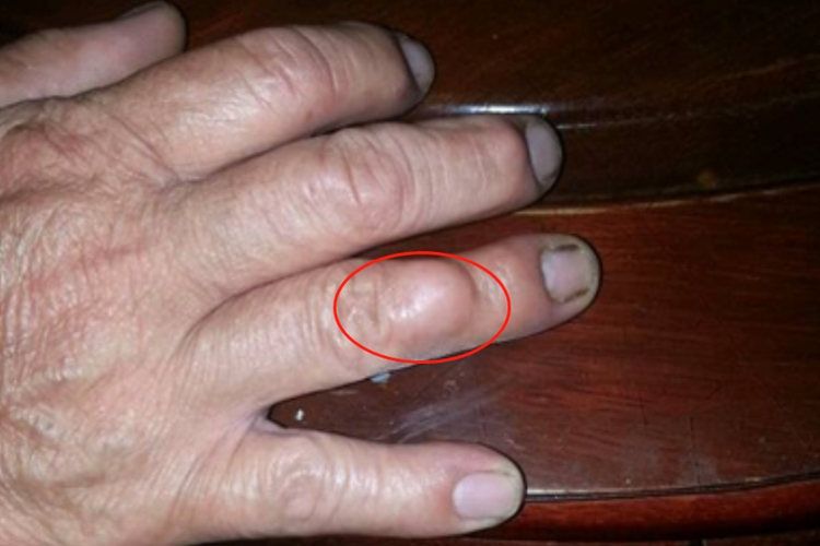 腱鞘巨细胞瘤手指肿块图