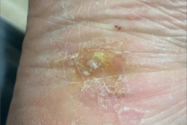 鳞屑角化型足癣增厚图