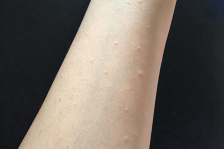 汗管瘤胳膊症状图 汗管瘤胳膊症状图