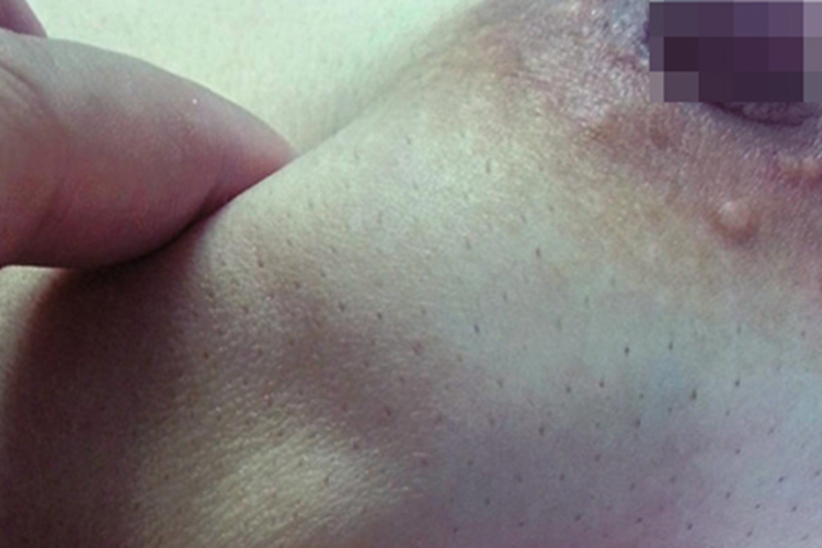 乳腺癌乳房大坑图