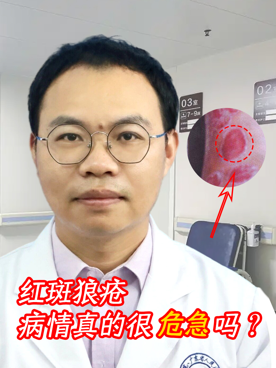 红斑狼疮，病情真的很危急吗？