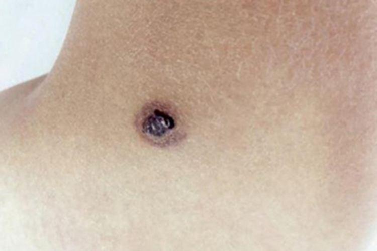 血管角化瘤后颈症状图