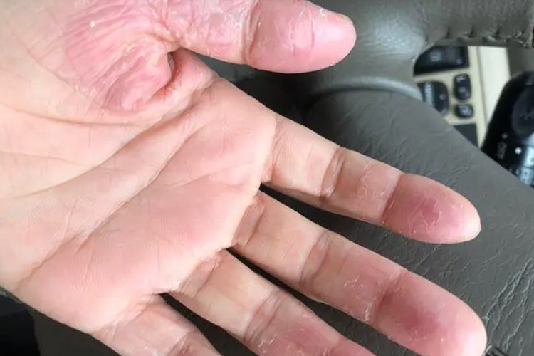 手部慢性湿疹角质增厚图