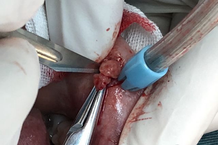 黏液腺囊肿分离囊壁图