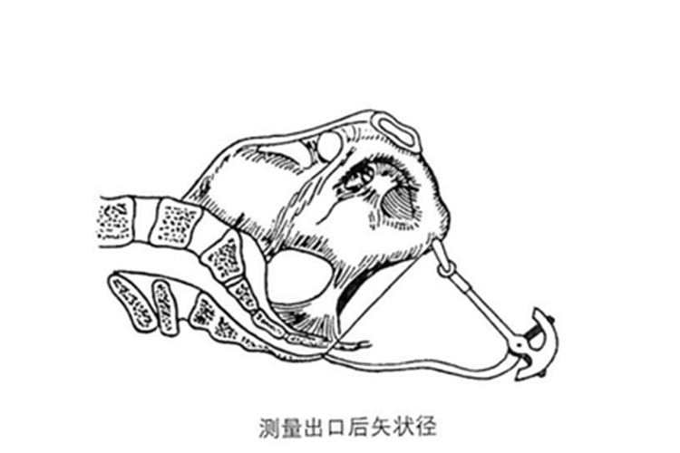 出口后矢状径测量图