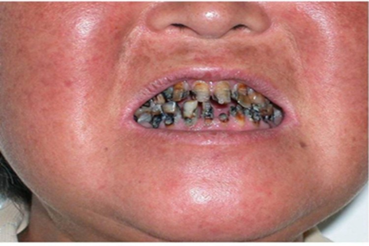 干燥综合征牙齿发黑图 干燥综合征牙齿发黑图