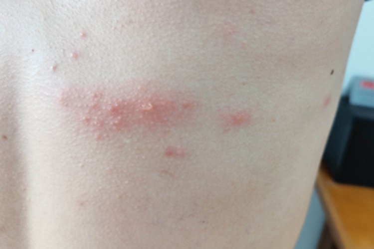 带状疱疹背部小水疱图