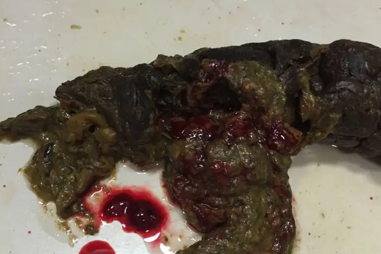 肛裂便中带血丝图