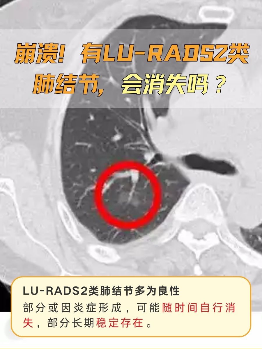 崩溃!有LU-RADS2类肺结节,会消失吗?