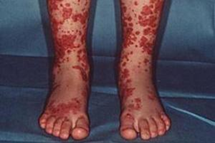 小孩特发性血小板减少性紫癜瘀斑图 小孩特发性血小板减少性紫癜瘀斑图