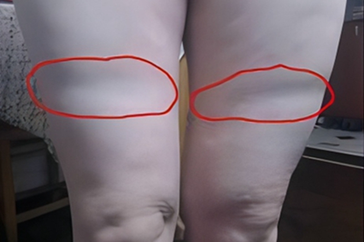环状脂肪萎缩大腿有横向凹陷图