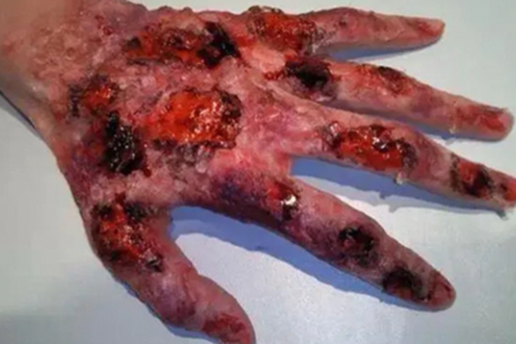 电弧烧伤手部糜烂图 电弧烧伤手部糜烂图