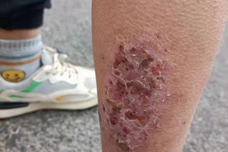 慢性湿疹小腿结痂图 慢性湿疹小腿结痂图