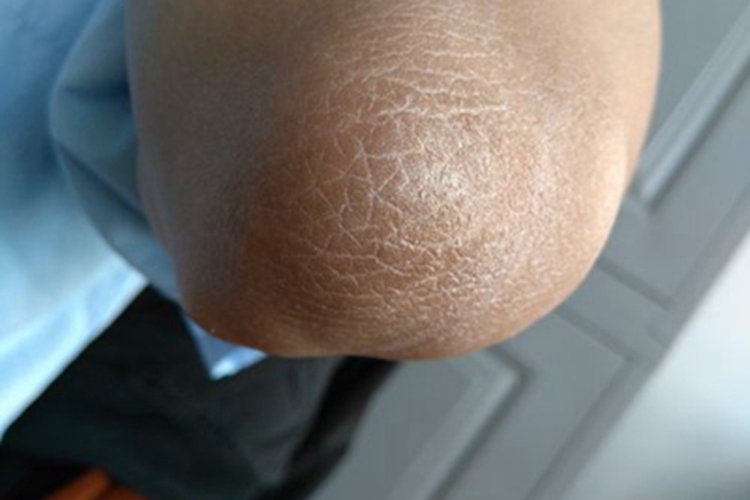 皮肤肥大细胞增生病胳膊症状图