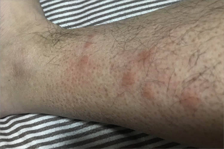 螨虫皮炎小腿症状图 螨虫皮炎小腿症状图