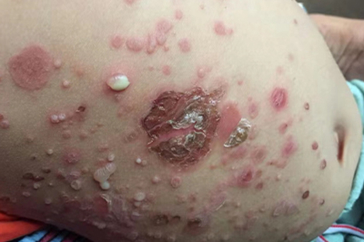 脓疱疮腹部症状图 脓疱疮腹部症状图