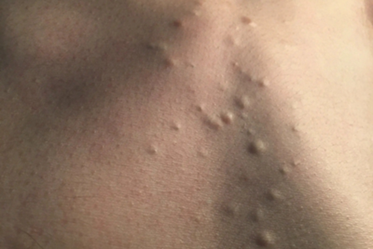 浅表性皮肤脂肪瘤痣胸部结节图