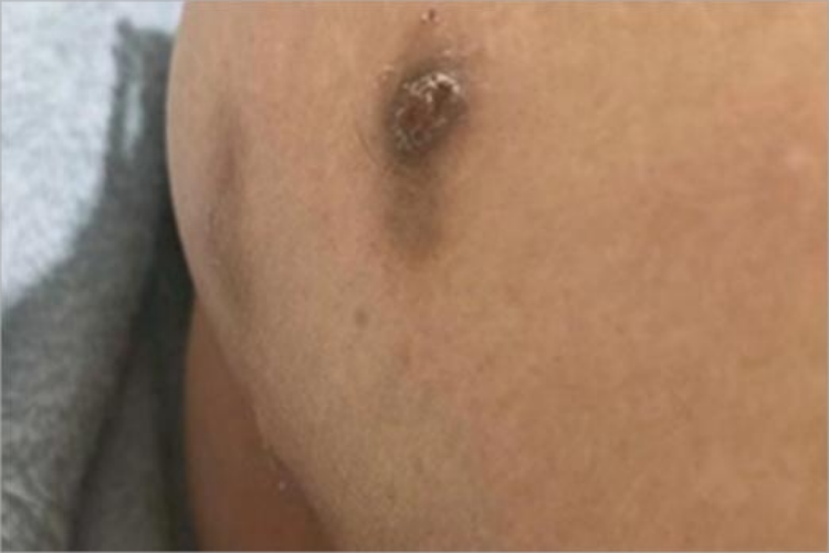 毛囊炎臀部结痂图