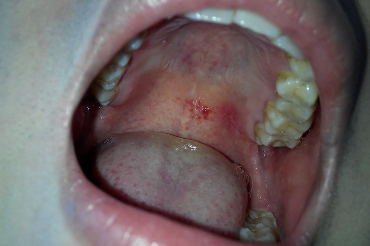 口腔黏膜红斑图