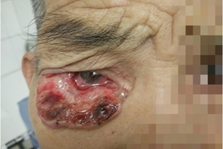 皮脂腺癌眼部硬结破溃图 皮脂腺癌眼部硬结破溃图