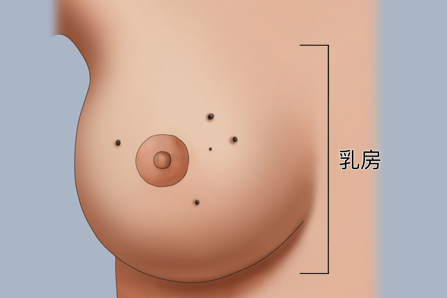 乳房周围的褐色扁平疣图