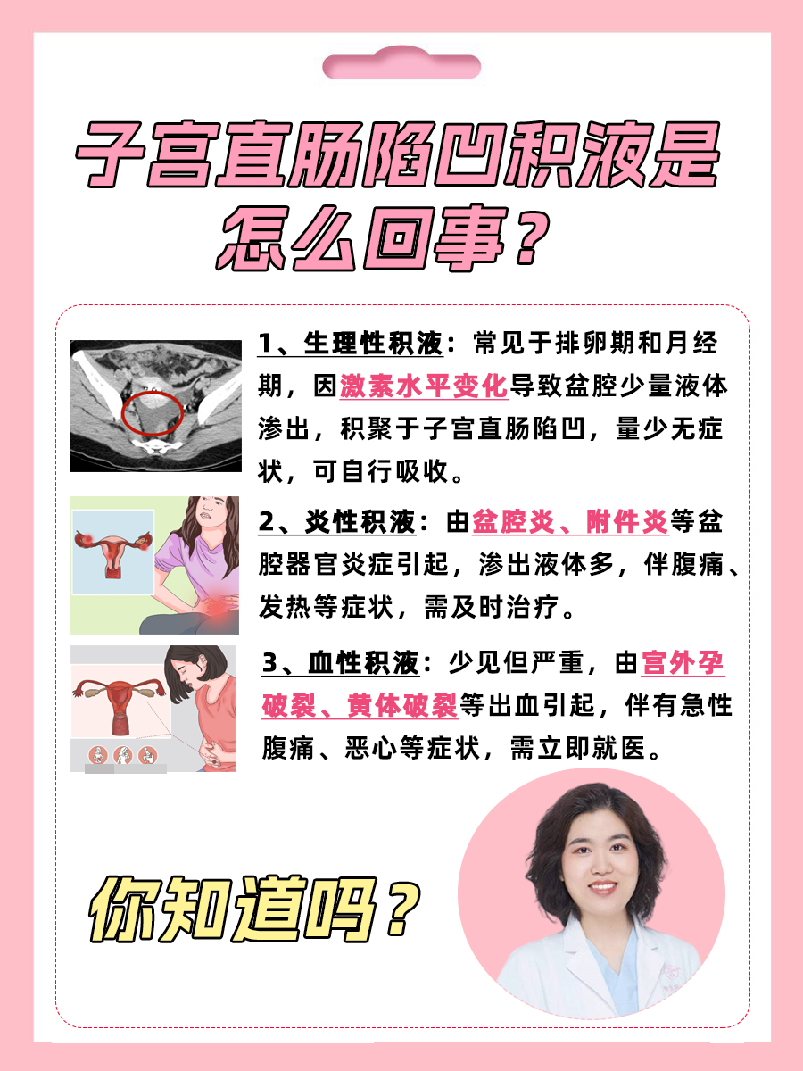 子宫直肠陷凹积液是怎么回事？你知道吗？