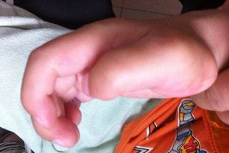 粘多糖病小孩Ⅳ型关节肿大图 粘多糖病小孩Ⅳ型关节肿大图