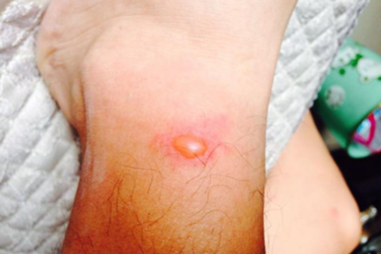 水痘脚踝长水疱周围发红图