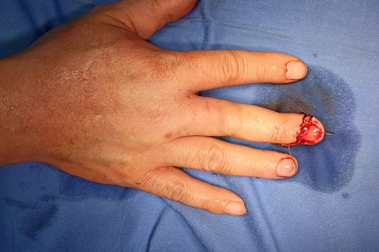 中指切伤大量流血图 中指切伤大量流血图