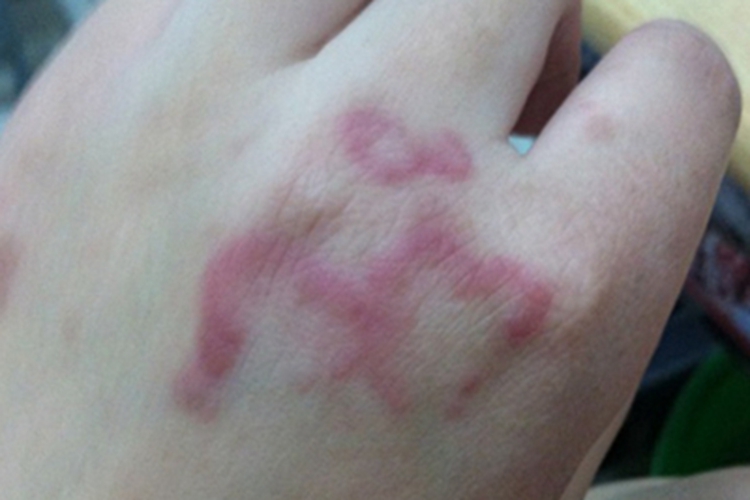 湿疹样紫癜手背症状图