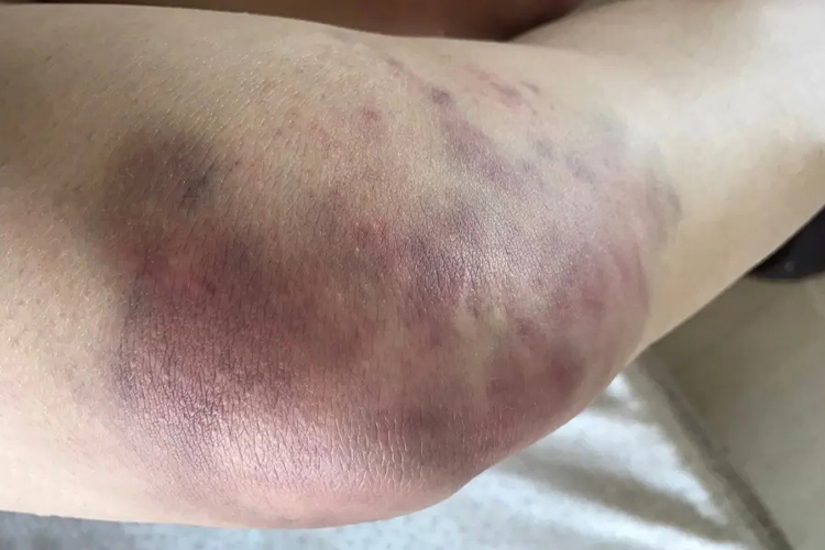 左侧胫骨平台骨折皮肤肿胀图