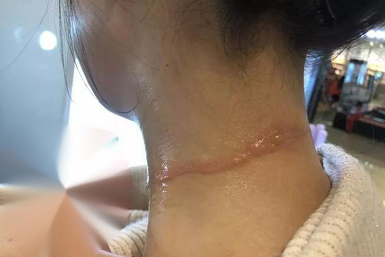 脖子烫伤增生性瘢痕图 脖子烫伤增生性瘢痕图