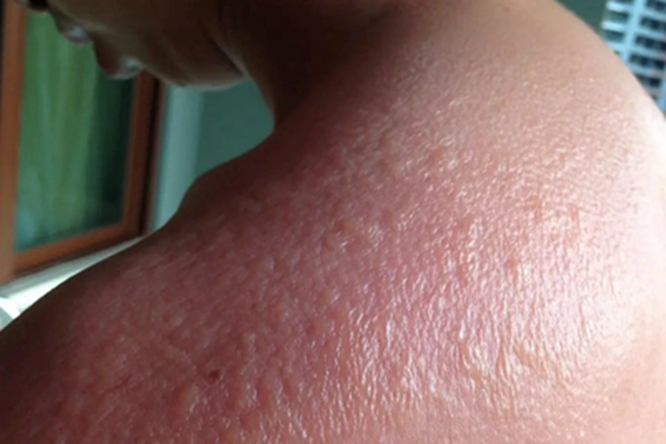 光毒性接触性皮炎肩部症状图 光毒性接触性皮炎肩部症状图