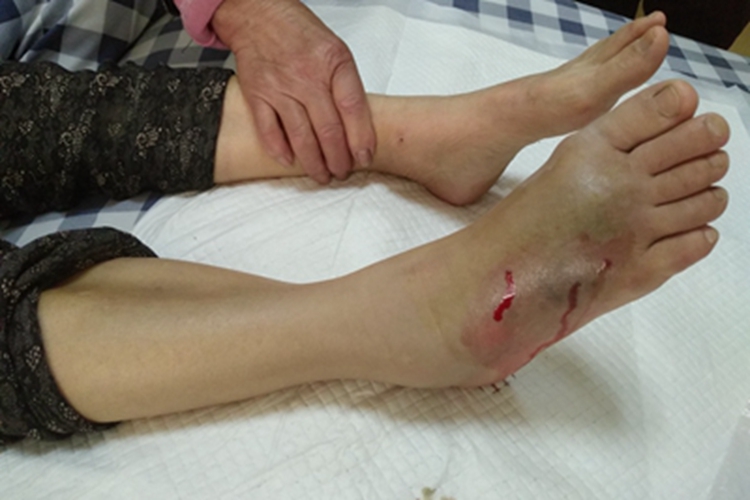 毒蛇咬伤肿块图 毒蛇咬伤肿块图