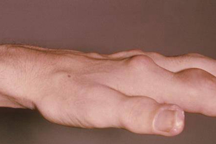 痛风手指上长好多硬疙瘩图